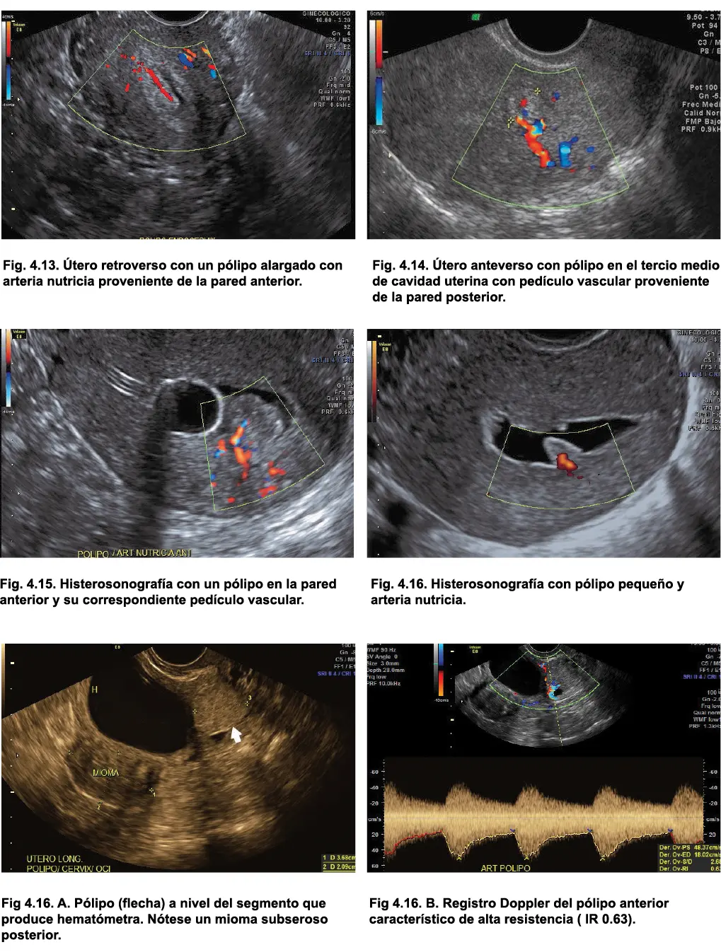 5 Ecoestructura y ecogenicidad Los pólipos endometriales en mujeres en etapa - фото 29