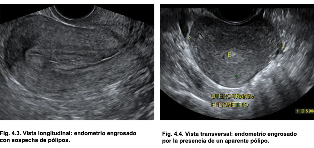 2 Interrupción de la línea media endometrial Los pólipos interrumpen o - фото 26