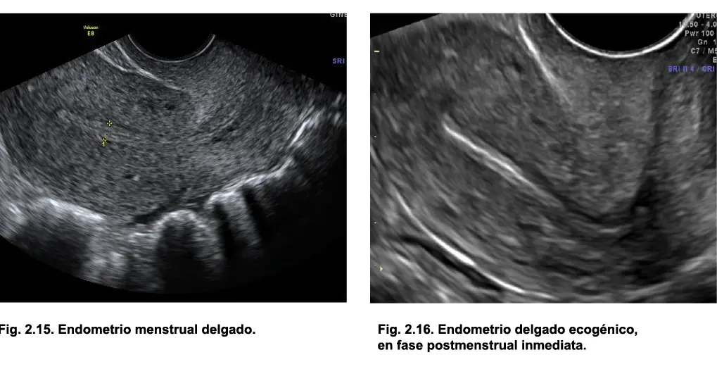 En fase periovulatoria proliferativa tardía el endometrio adopta una - фото 16