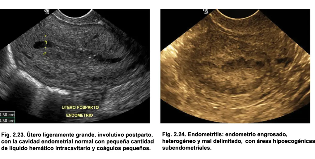 Endometrio en la postmenopausia En la postmenopausia el endometrio sano debe - фото 18