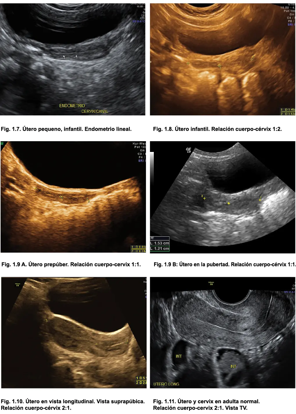 Menopausia El útero sufre atrofia y presenta calcificaciones vasculares - фото 9