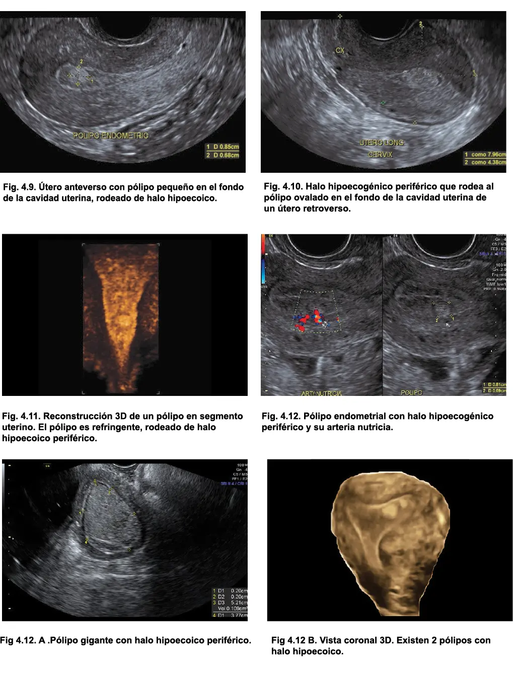 4 Pedículo vascular Usualmente por medio del Doppler color puede - фото 28