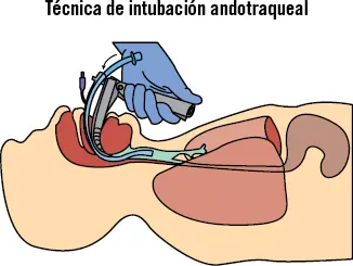 34 Dispositivos faringoesófagotraqueales La intubación endotraqueal IE es - фото 28