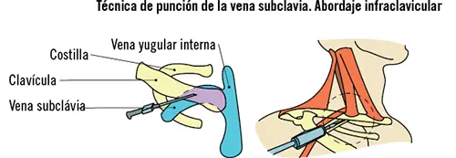 Técnica de punción de la vena yugular interna Esta técnica se desarrolla - фото 14