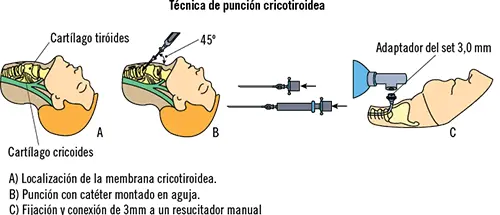 Complicaciones Como toda técnica también pueden derivarse complicaciones de su - фото 46