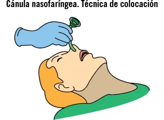 33 Intubación endotraqueal La intubación endotraqueal IET constituye el - фото 25