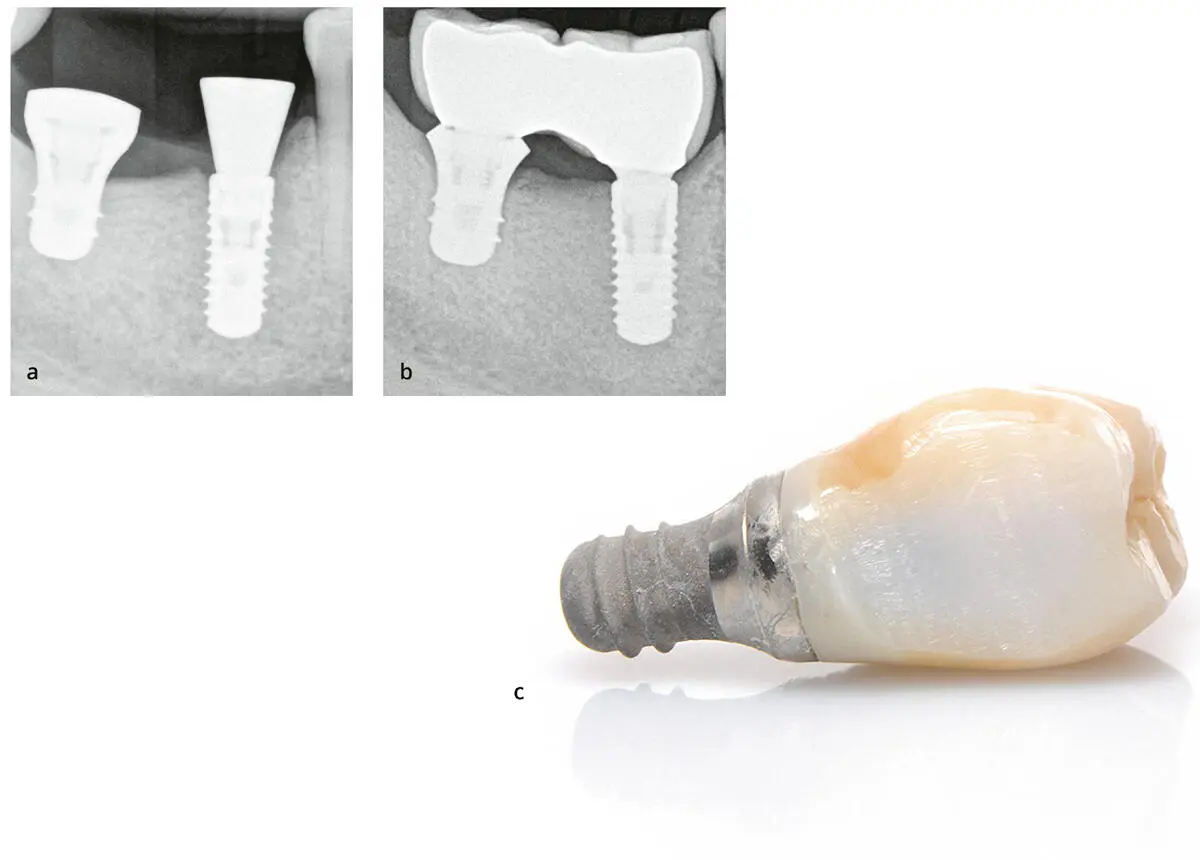 Abb 111Klinisches Beispiel Der initiale krestale Knochenverlust ist bei - фото 30