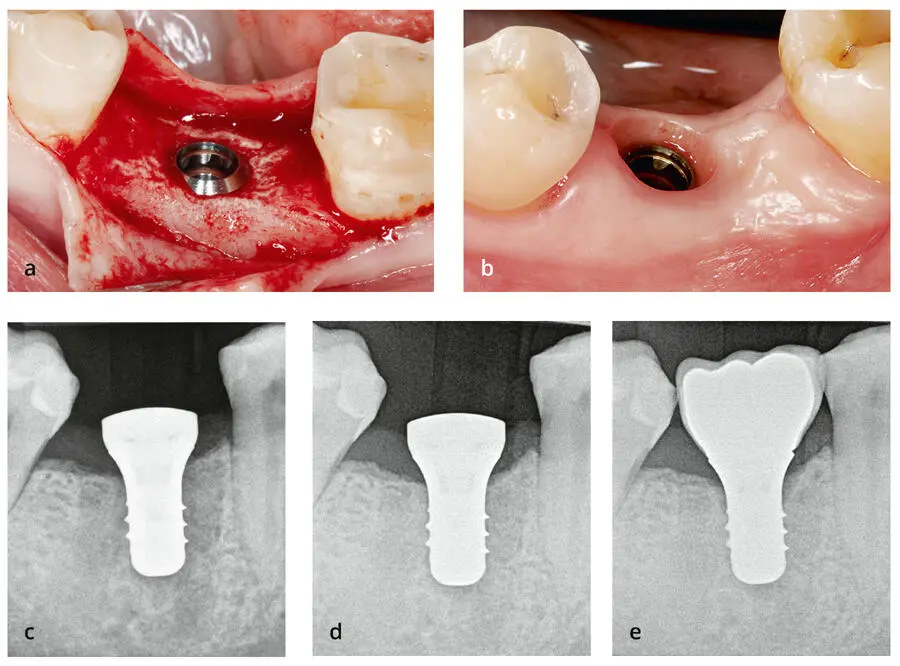 Abb 314Klinisches Beispiel und Folgen eines zu tief gesetzten Implantats auf - фото 78