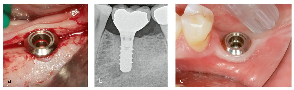 Abb 26 a Dieses Implantat auf Gewebeniveau wurde korrekt gesetzt Der - фото 45