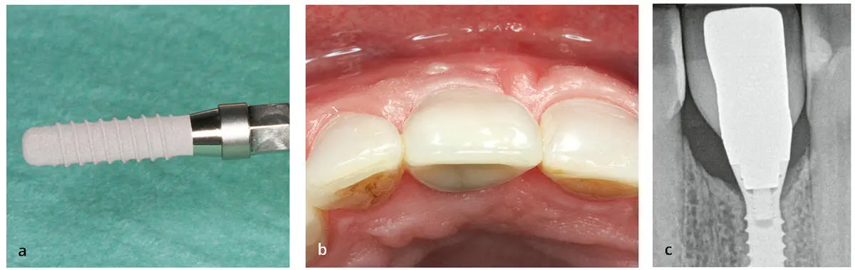 Abb 24 a Implantat mit poliertem Hals b und c Der Knochenverlust - фото 43