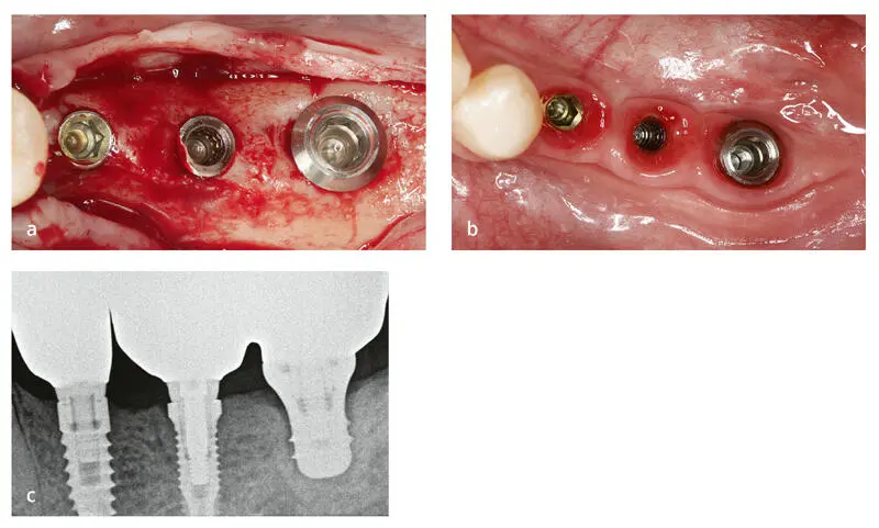 Abb 25Verschiedene Knochenreaktionen auf Implantate mit unterschiedlichem - фото 44