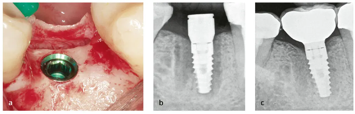 Abb 214 a bis c Ein Mikrospalt zwischen Implantat und Abutment führt zur - фото 53