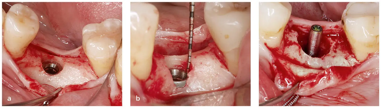 Abb 38Verschiedene subkrestale Positionen von Implantaten mit - фото 72