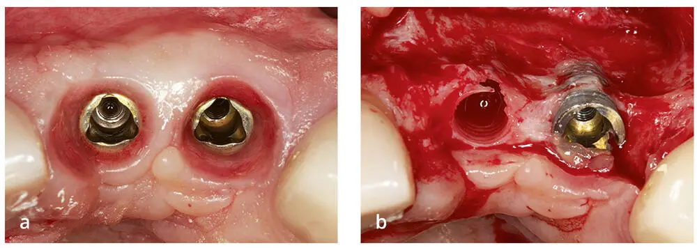 Abb 112Nicht korrekte dreidimensionale Position des Implantats a Die - фото 31