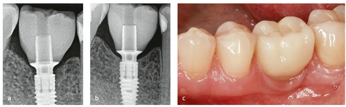 Abb 16Remineralisierung des krestalen Knochens an Implantaten V3 Fa MIS - фото 25