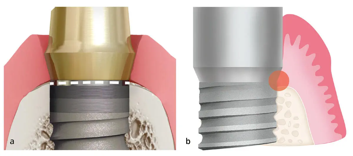 Abb 212Nicht korrekt platziertes Implantat ohne PlatformSwitching a Der - фото 51