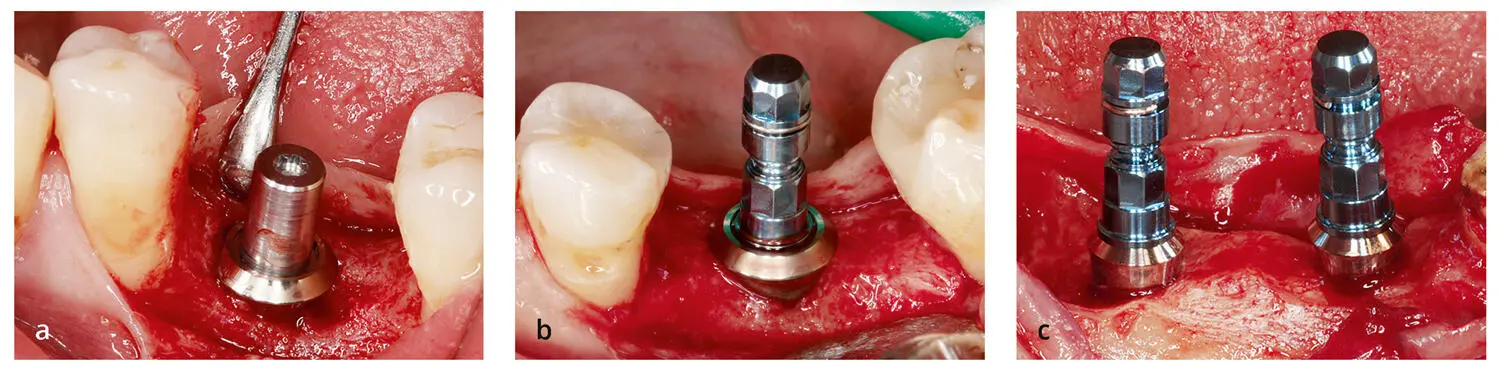 Abb 313 a Dieses Implantat wurde zu tief gesetzt Der polierte Hals und der - фото 77