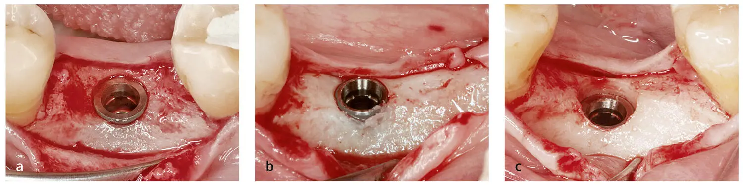 Abb 37Verschiedene Positionen von Implantaten mit PlatformSwitching bezogen - фото 71
