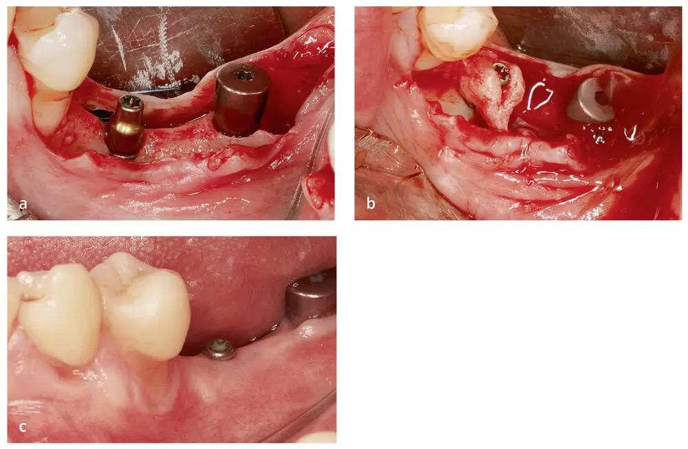 Abb 310 a Suprakrestale Position der bukkalen Implantatoberfläche b - фото 74