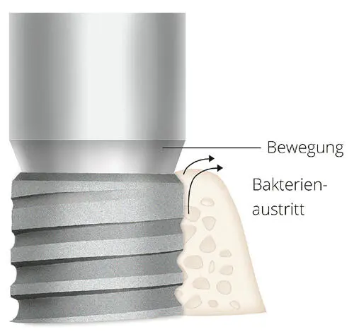 Abb 29Sofern eine ImplantatAbutmentVerbindung d h der Mikrospalt - фото 48