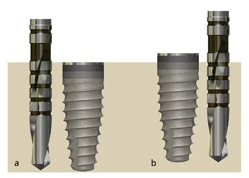 Abb 215 a Wenn ein Implantat ohne PlatformSwitching auf oder unter - фото 54