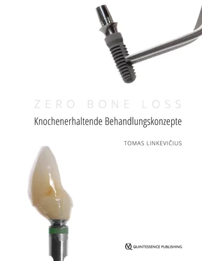 Tomas Linkevičius Zero Bone Loss: Knochenerhaltende Behandlungskonzepte обложка книги