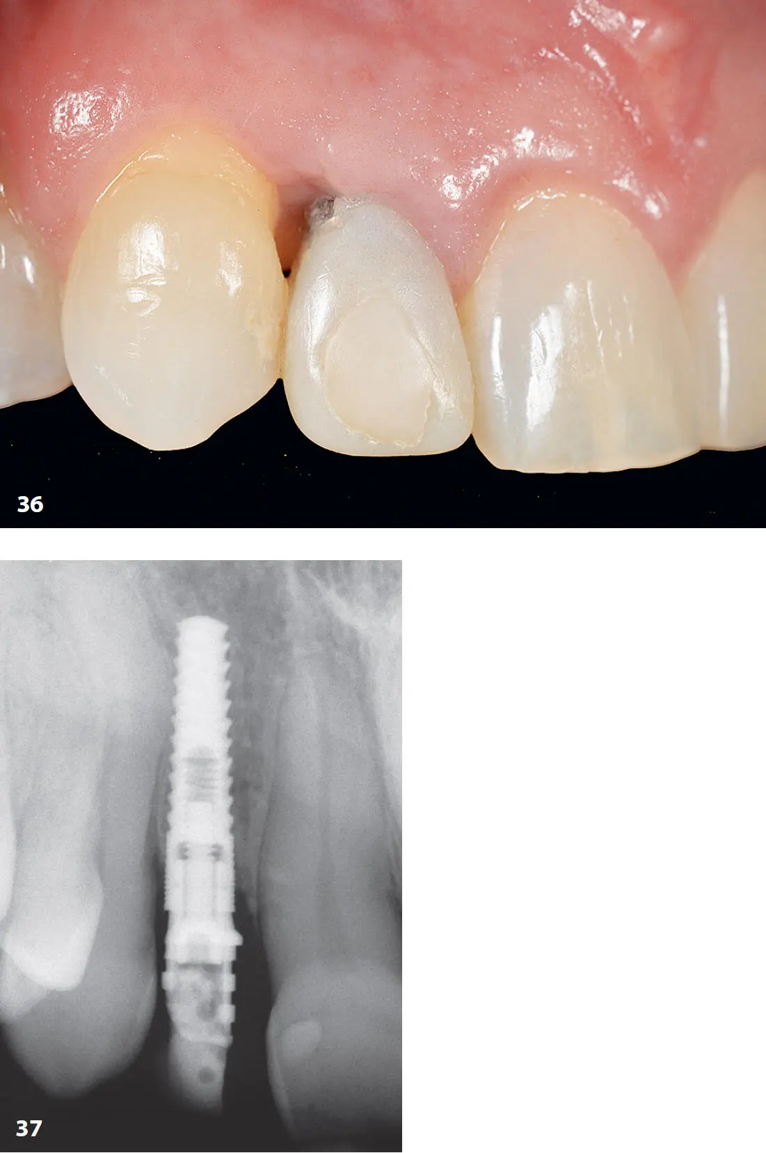 Abb 36 Intraorale Ansicht eines zu weit fazial und distal und zu nahe neben - фото 14