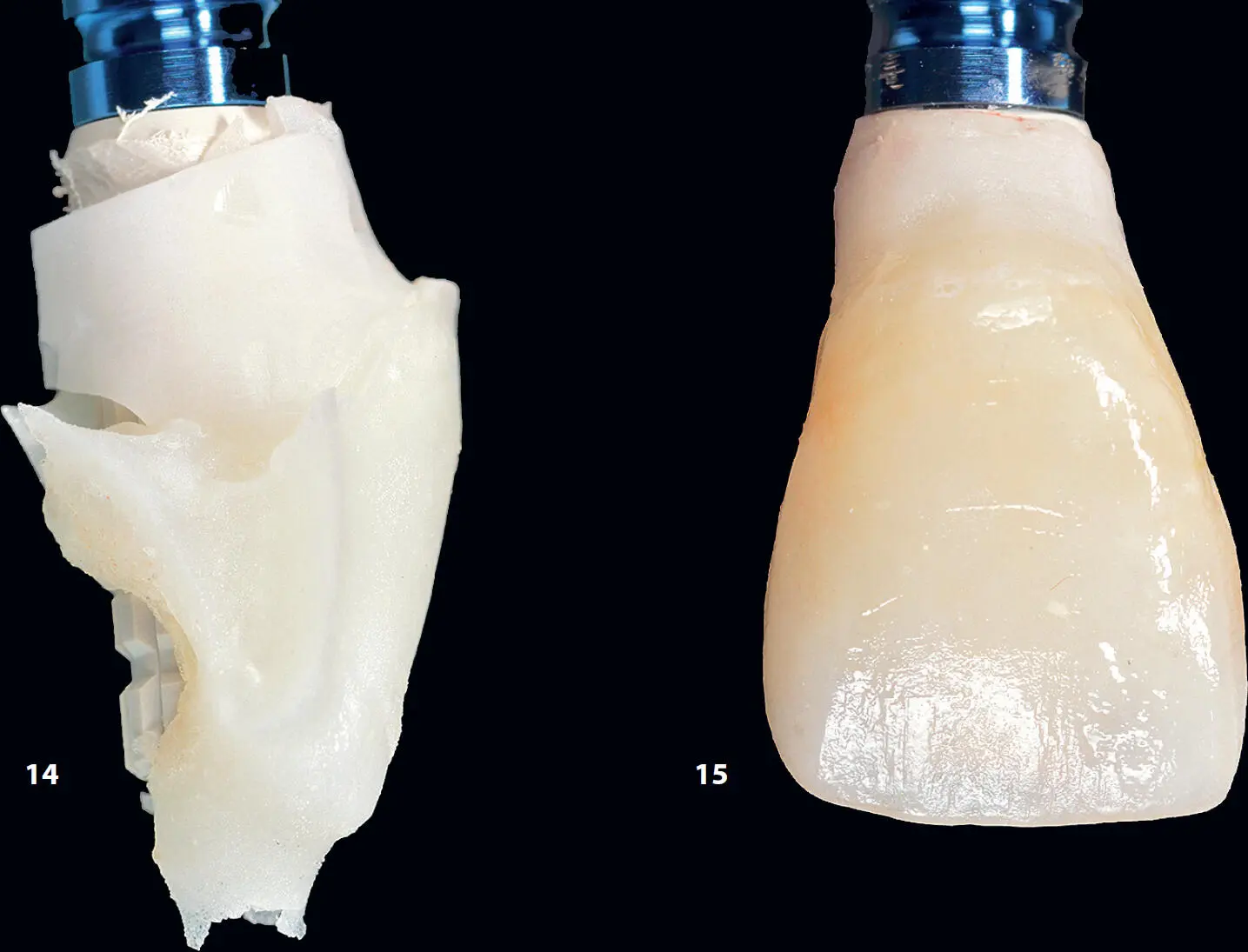 Die provisorische Kronenrestauration wurde erneut auf das Implantat gesetzt um - фото 8