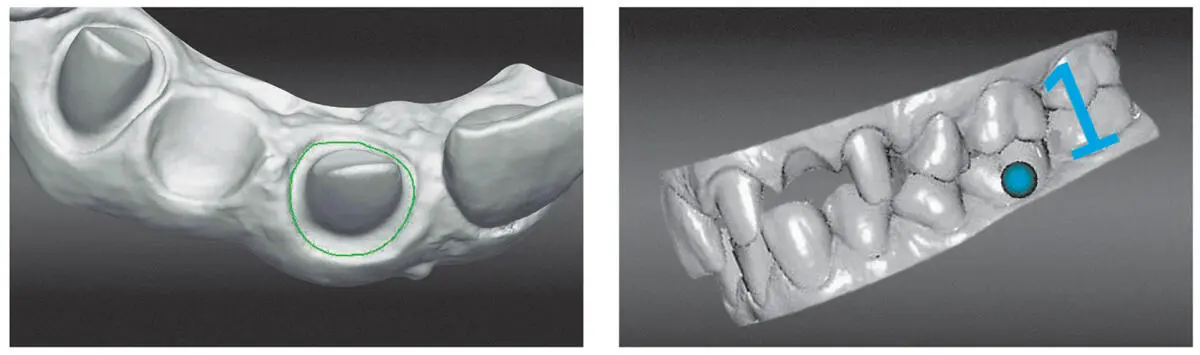 Fig 23Rendered 3D data from an intraoral scanner Zfx Dachau Germany - фото 11