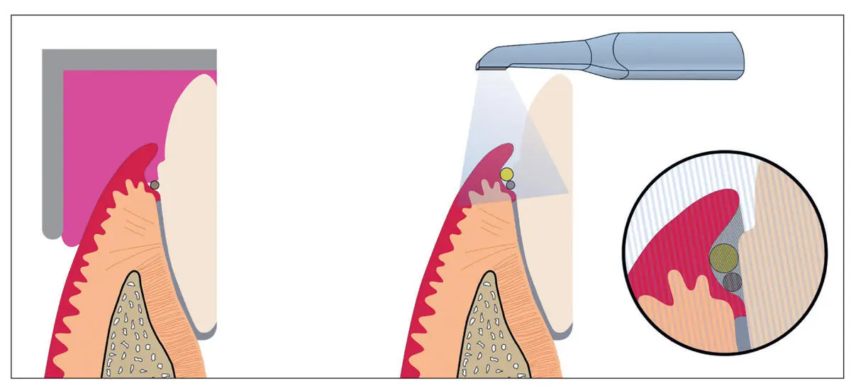 Fig 28A representative image of a clinical situation using conventional and - фото 16