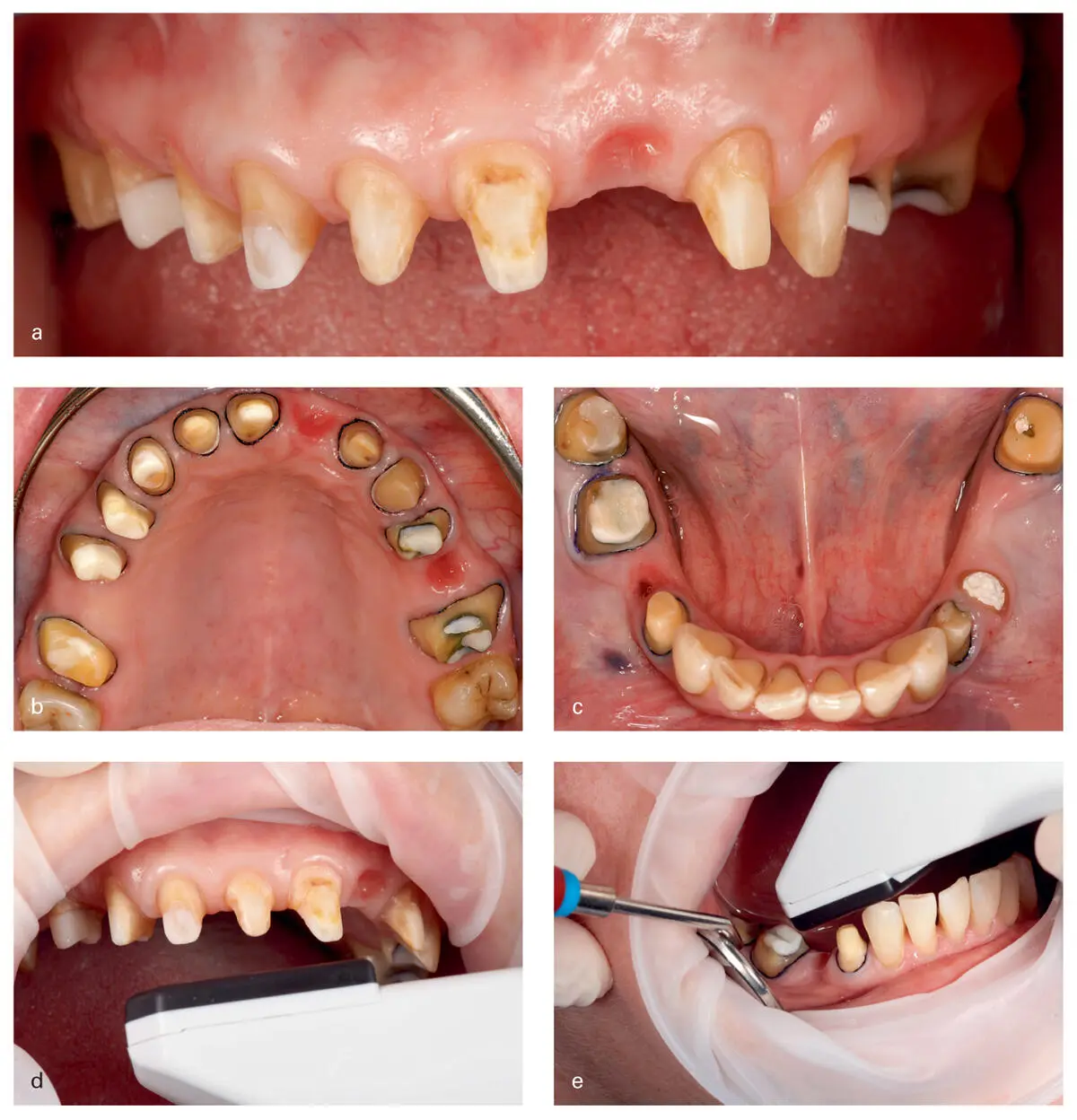 Fig 221Intraoral frontal and occlusal views of the prepared abutment teeth a - фото 30
