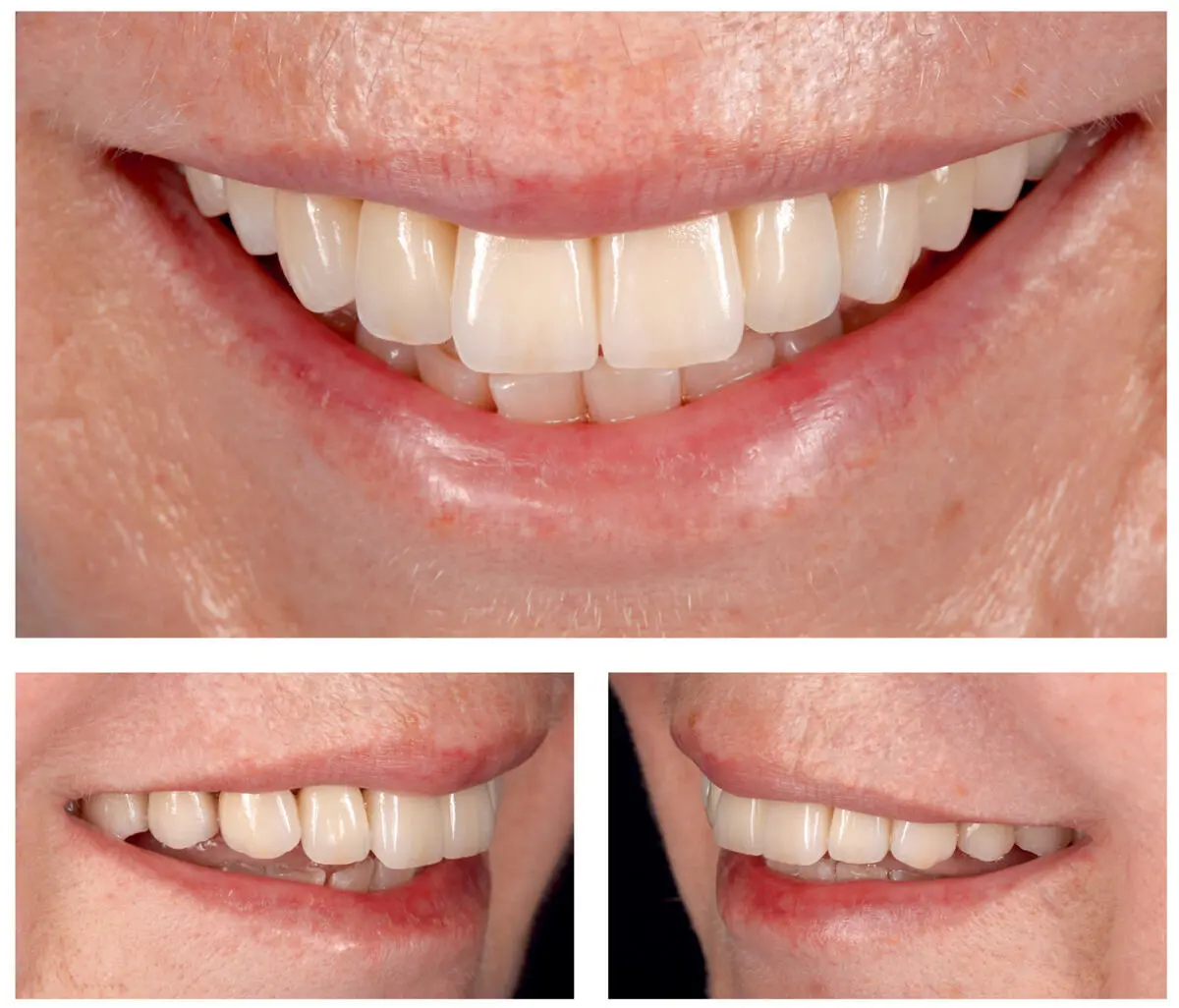 Fig 229Frontal lateral views of the patients smile showing a successful - фото 38