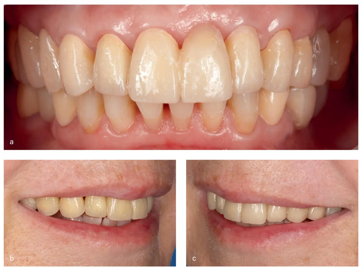 Fig 220An intraoral frontal view of the inserted provisionals a Side views - фото 29