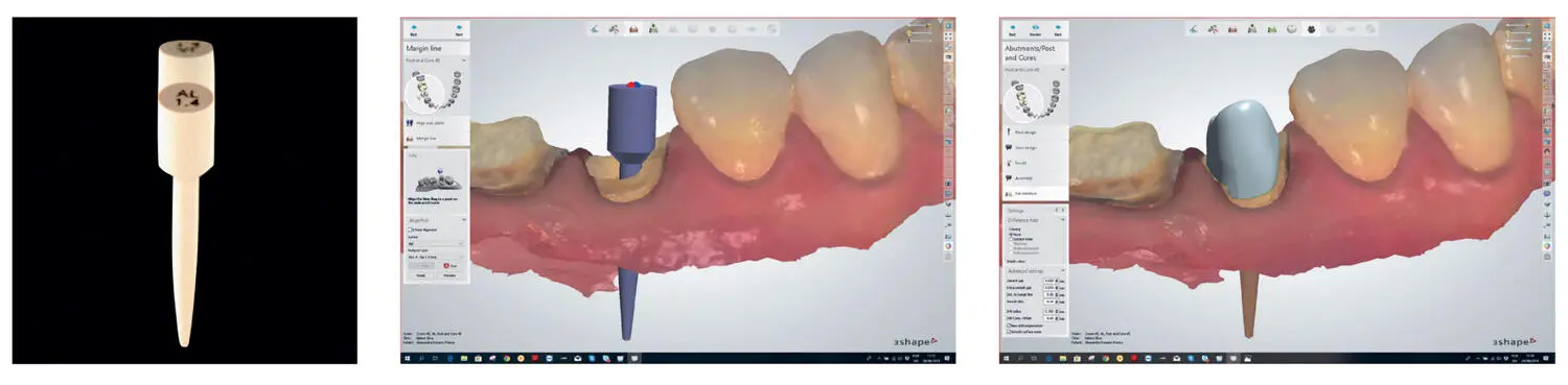 Fig 217The 3Shape Scan Post system is approved for both intraoral application - фото 26