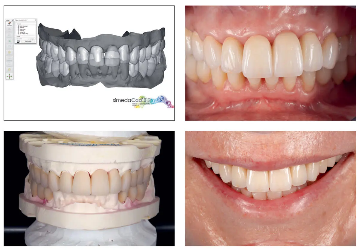 Fig 224The SimedaCad 20 software was used to design the restorations A - фото 33