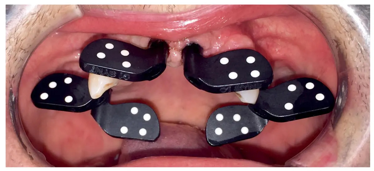 Fig 215Clinical example demonstrating the positioning of PIC abutments onto - фото 23
