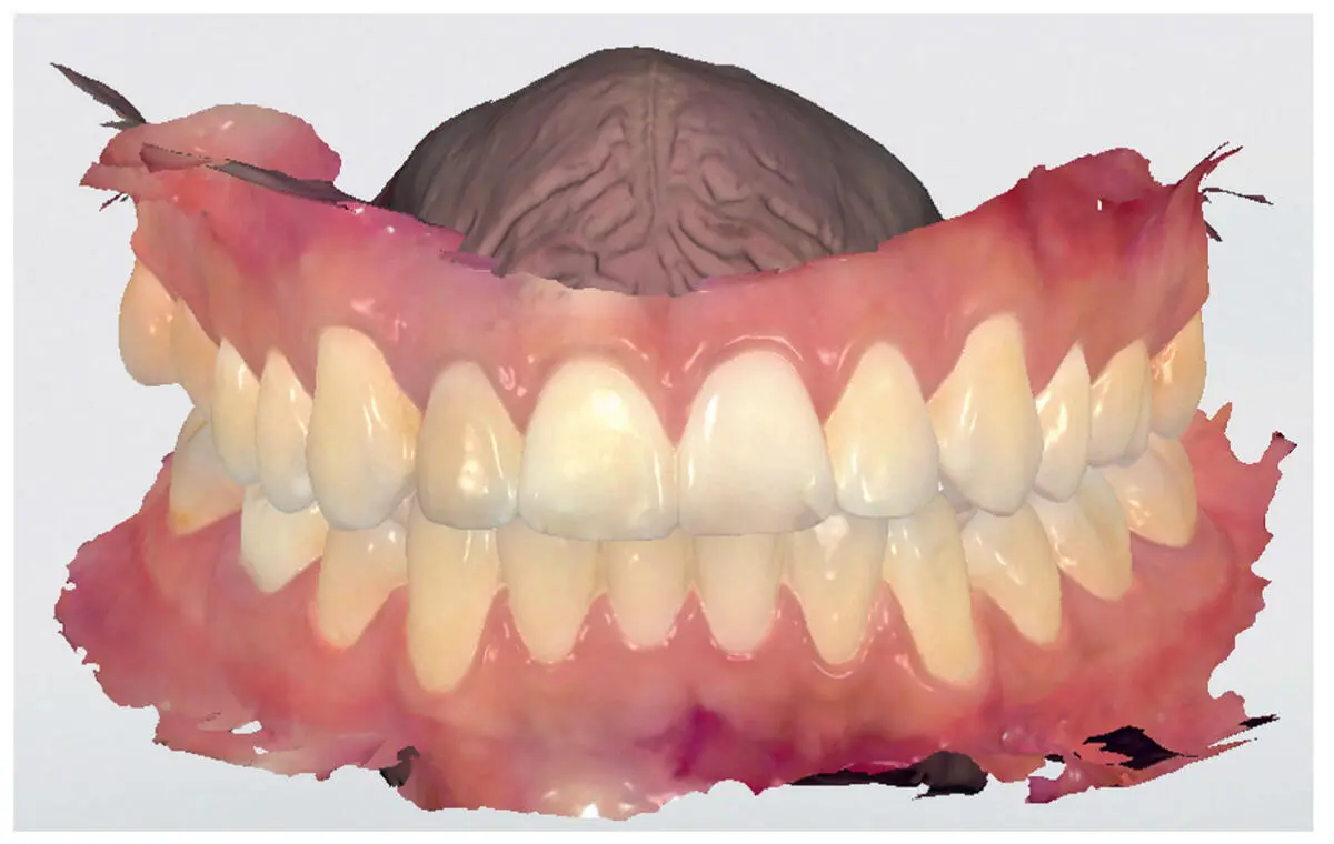 Fig 25Rendered model in RealColor after scanning with Trios 3Shape - фото 13
