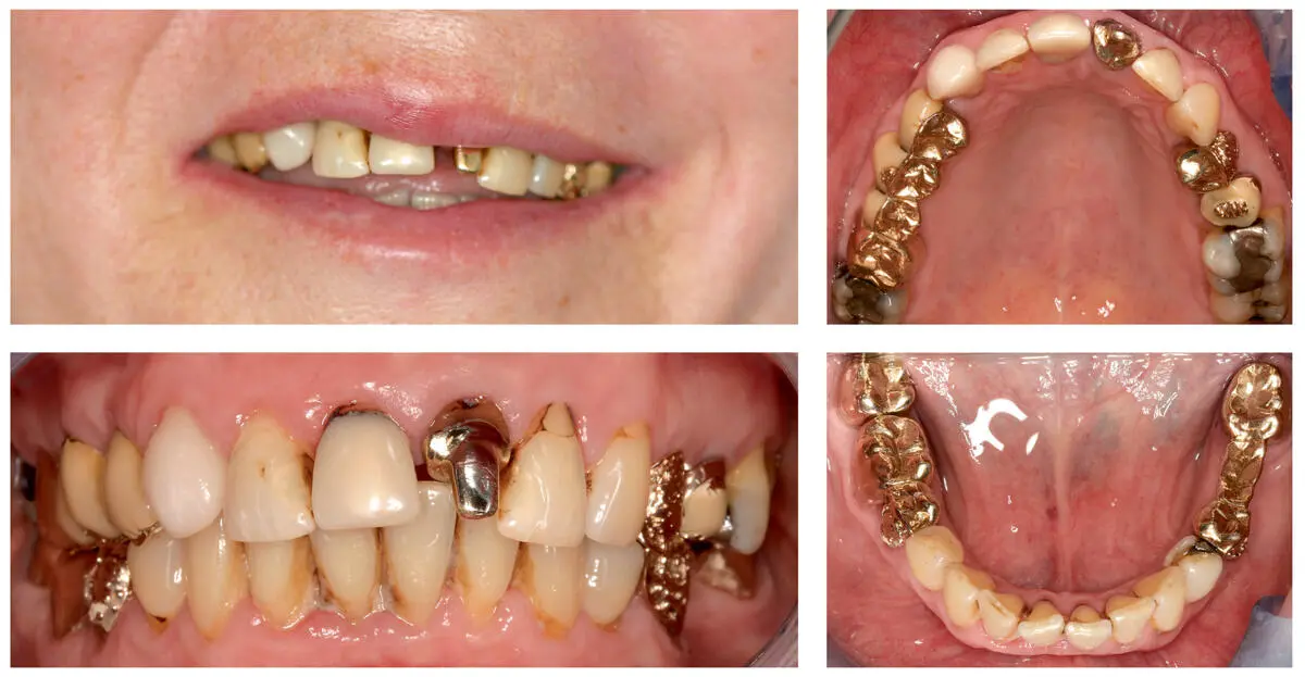 Fig 218A photo of the patients smile showing intraoral anterior and occlusal - фото 27