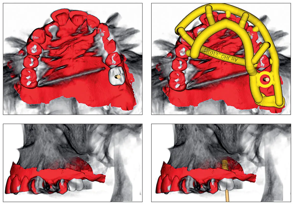Fig 211Consequently a virtual setup of the missing tooth can be performed - фото 19