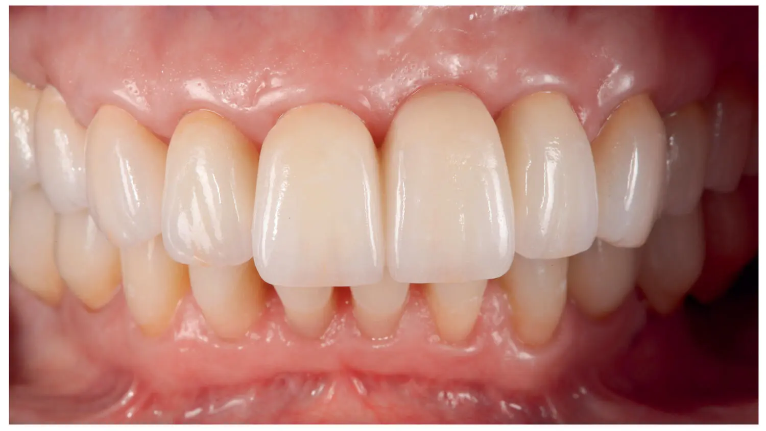 Fig 227Frontal view of the final crowns after cementation Fig 228Lateral - фото 36