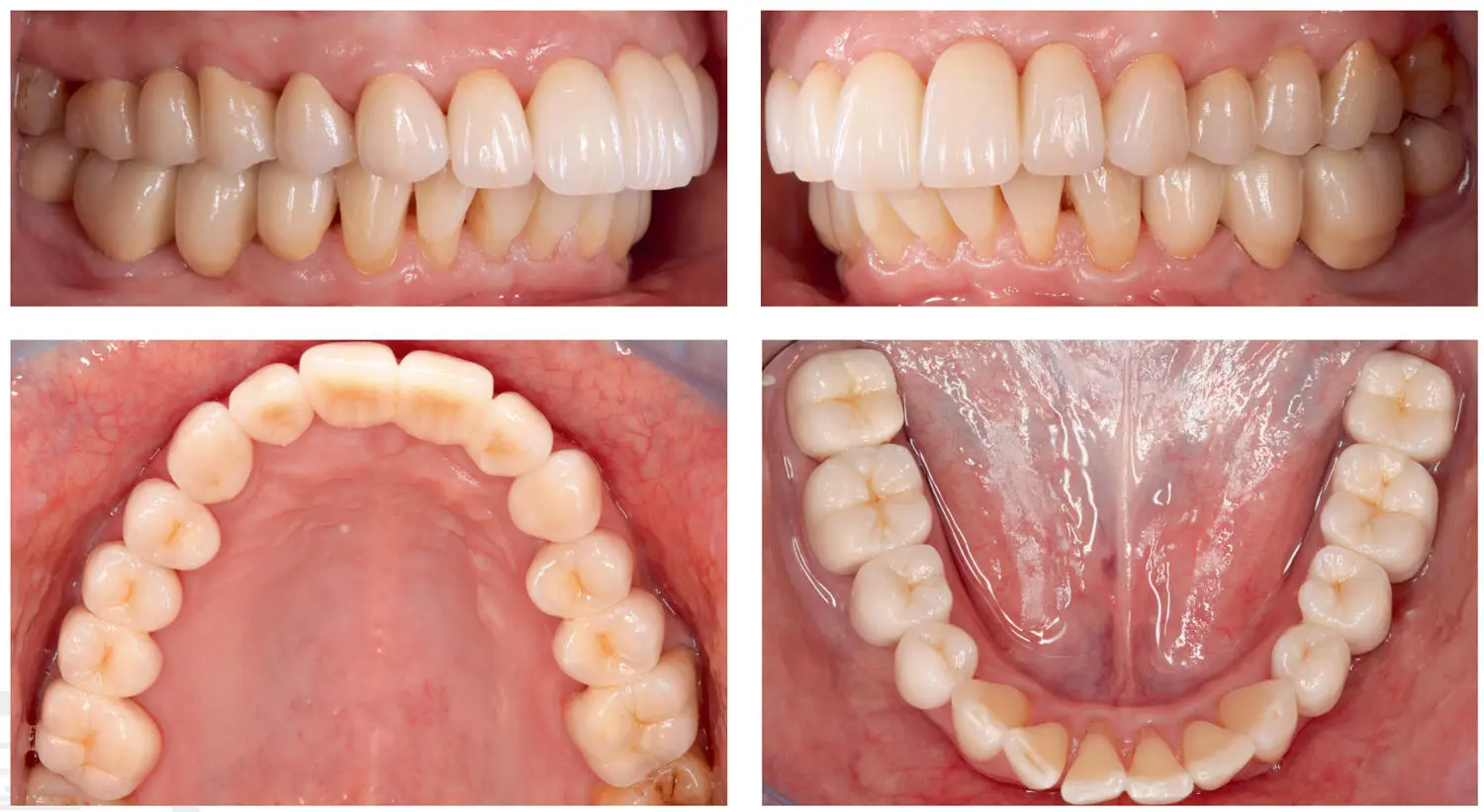 Fig 228Lateral and occlusal views of the cemented restorations Fig - фото 37