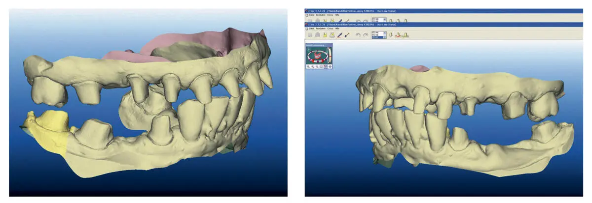 Fig 222Interocclusal relationship of the scanned images The obtained data - фото 31