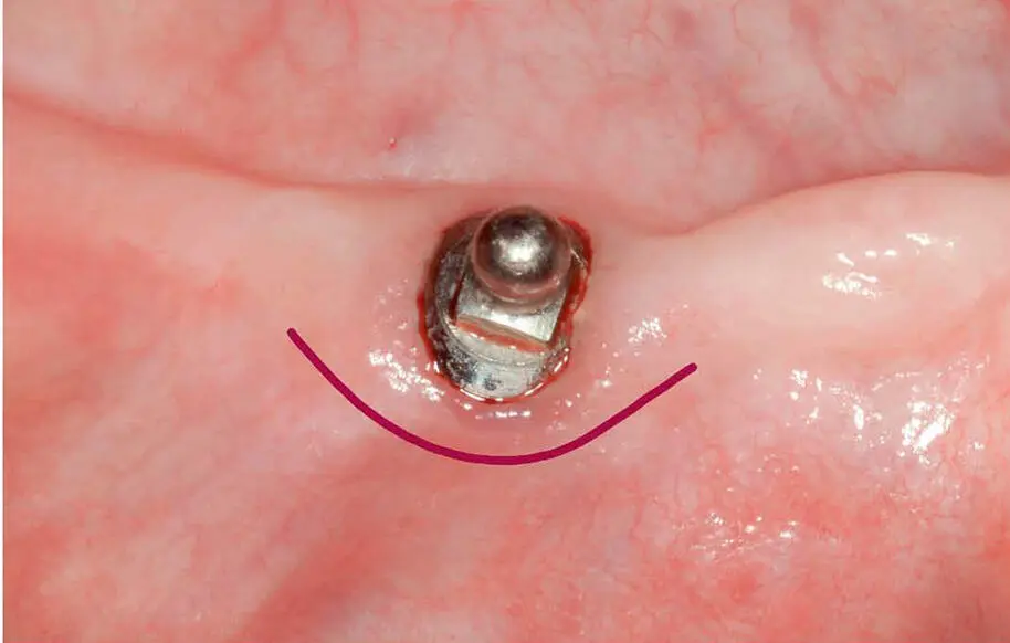 Abb 46Einzeichnung der paramarginalen Inzision labial des Implantats Regio 43 - фото 116
