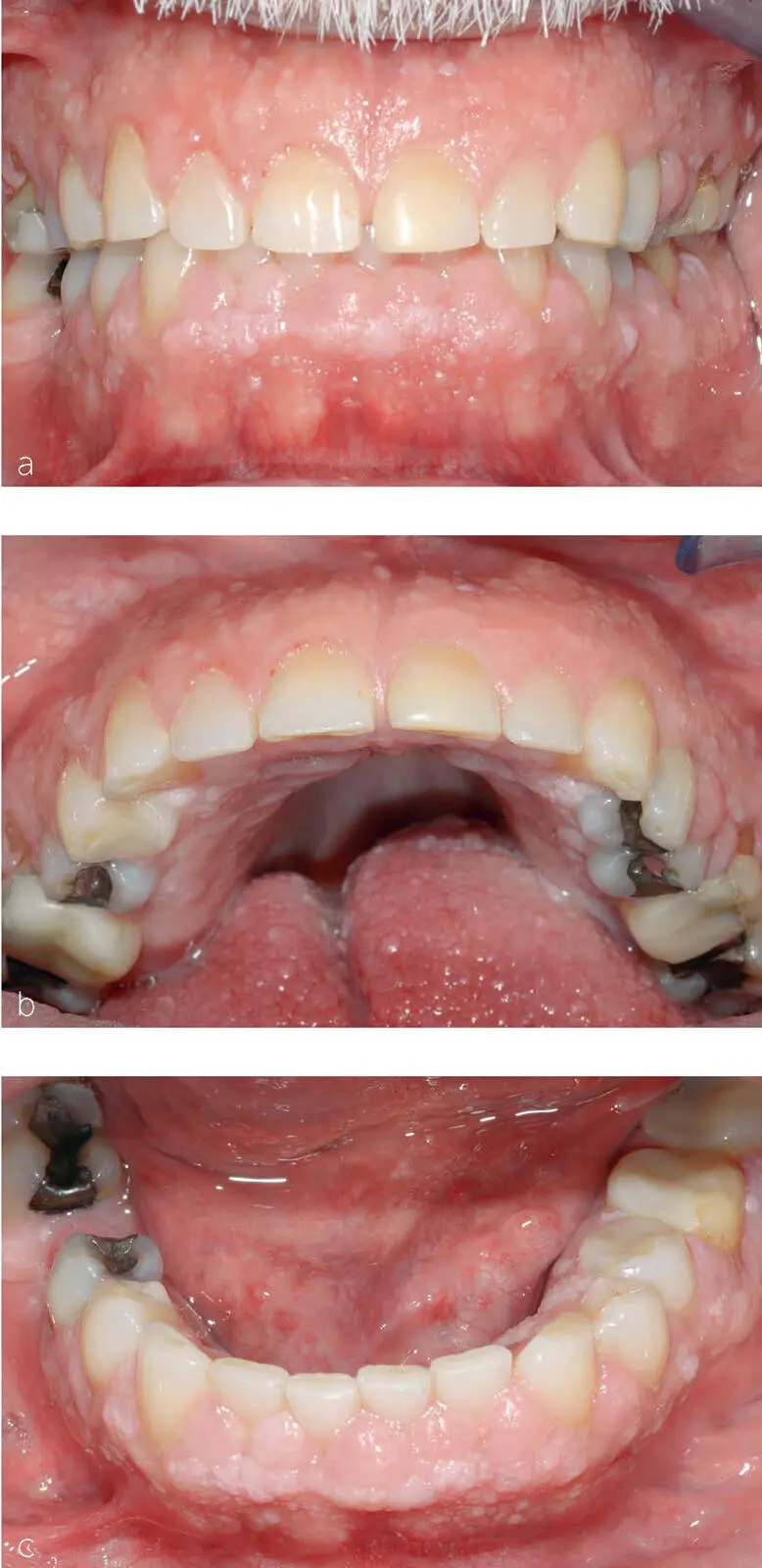 Abb 15Generalisierte Wucherungen an der Gingiva im Ober und Unterkiefer a - фото 10