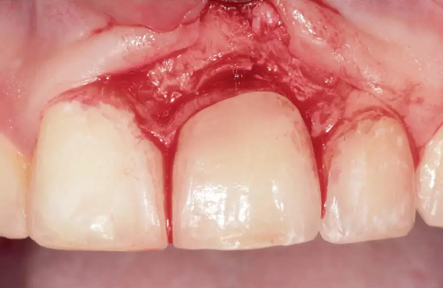 Abb 43Darstellung des labialen Knochensequesters nach erfolgter Inzision und - фото 113