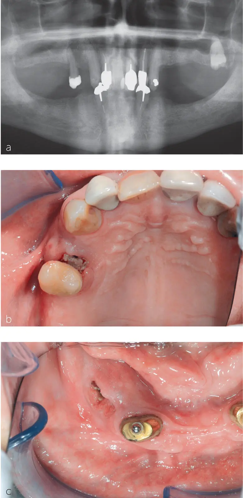 Abb 13Die Panoramaschichtaufnahme a eines 77jährigen Patienten mit - фото 8