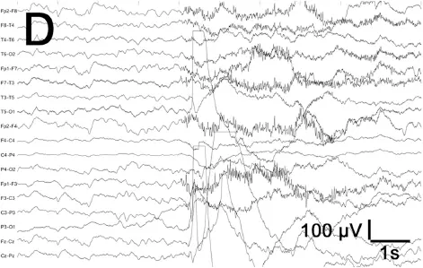 D Klinische und elektrophysiologische Remission ca 2 min nach Abschluss der - фото 45