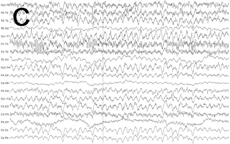C Keine wesentliche Änderung nach 6 mg Lorazepam iv D Klinische und - фото 44