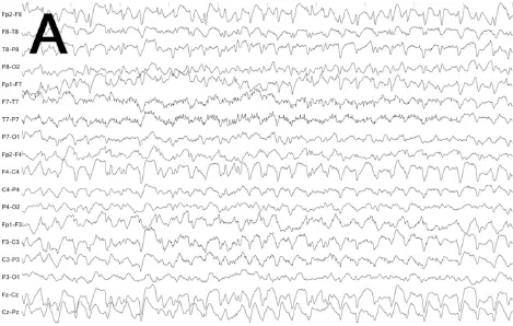 Abb 22 EEG zu Fall 22 bipolare Längsreihen A Bifrontale rhythmische - фото 42