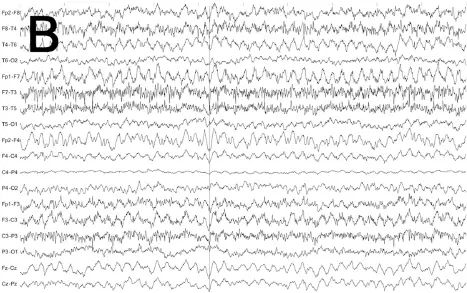 B Weiterhin Statusmuster jetzt generalisierte rhythmische - фото 43